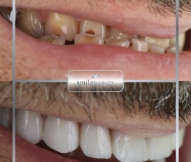 E.max no-prep veneers. E.max no-prep veneers Hollywood Smile result, Smile Infinity Beirut, Lebanon