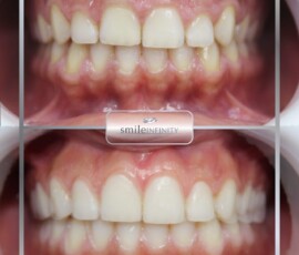Before and after - gummy smile treatment. Gummy smile before and after, Smile Infinity Beirut, Lebanon