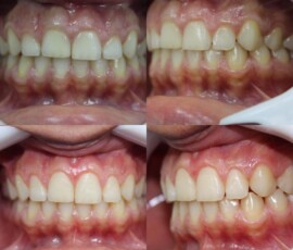 Gummy smile - clinical before and after views. Gummy smile clinical views before and after, Smile Infinity Beirut, Lebanon
