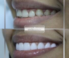 Before and after - gummy smile correction. Gummy smile correction before and after, Smile Infinity Beirut, Lebanon