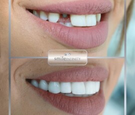 Gummy smile refined with laser, then restored. Gummy smile laser correction before and after, Smile Infinity Beirut, Lebanon