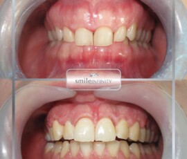Before and after - gummy smile treatment. Gummy smile treatment before and after, Smile Infinity Beirut, Lebanon
