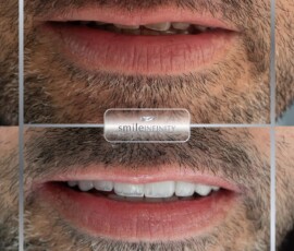 A completed Hollywood Smile by Dr. Habib Zarifeh. Full Hollywood Smile result by Dr. Habib Zarifeh, Smile Infinity Beirut, Lebanon