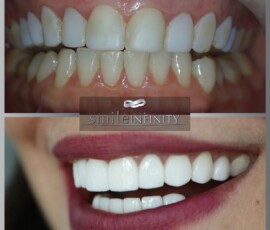 Matching a veneer's shade to the natural smile. Hollywood Smile veneer shade match before and after, Smile Infinity Beirut, Lebanon