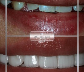 Before and after - worn, discoloured teeth restored with veneers. Hollywood Smile veneers before and after, worn discoloured teeth to bright white, Smile Infinity Beirut, Lebanon