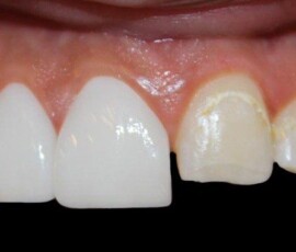 Smile design in harmony with lip aesthetics. Hollywood Smile with lip aesthetics result, Smile Infinity Beirut, Lebanon