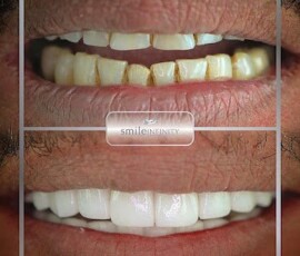 Before and after - Lumineers. Lumineers before and after for discoloured teeth, Smile Infinity Beirut, Lebanon