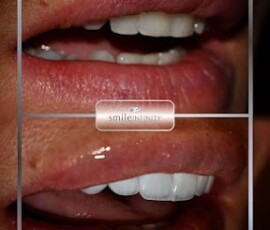 Before and after - Lumineers. Lumineers CAD/CAM result, Smile Infinity Beirut, Lebanon