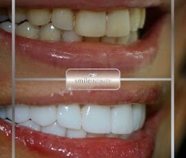 A natural-looking Lumineers Hollywood Smile. Natural Lumineers Hollywood Smile result, Smile Infinity Beirut, Lebanon