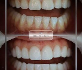 Before and after - Lumineers, no drilling. Lumineers no-drilling bonding result, Smile Infinity Beirut, Lebanon
