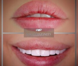 No-prep Lumineers - full smile result. No-prep Lumineers Hollywood Smile result with lip aesthetics, Smile Infinity Beirut, Lebanon