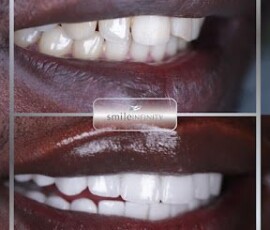 Ultra-thin Lumineers - the finished look. Ultra-thin Lumineers veneers result by Dr. Habib Zarifeh, Smile Infinity Beirut, Lebanon