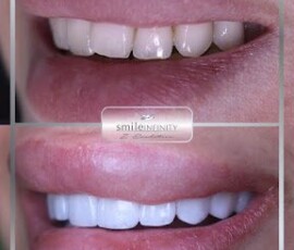 Before and after - porcelain veneers. Porcelain veneers before and after Hollywood Smile, Smile Infinity Beirut, Lebanon