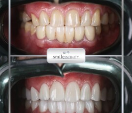 Before and after - porcelain veneers. Porcelain veneers before and after, Smile Infinity Beirut, Lebanon