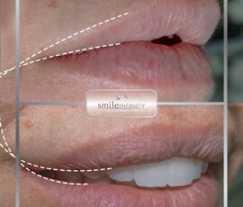 Before and after - the Smile Lift by Dr. Habib Zarifeh. Smile Lift before and after by Dr. Habib Zarifeh, Smile Infinity Beirut, Lebanon