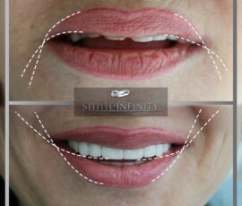 Before and after - Smile Lift. Smile Lift before and after with lip-line analysis, Smile Infinity Beirut, Lebanon