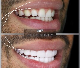Before and after - Smile Lift, side profile. Smile Lift before and after, side profile, Smile Infinity Beirut, Lebanon