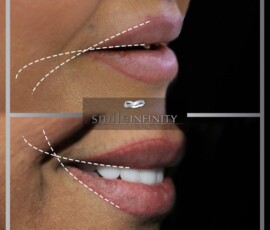 Before and after - Smile Lift result. Smile Lift before and after result, Smile Infinity Beirut, Lebanon