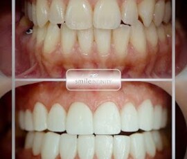Before and after - full-arch veneers. Porcelain veneers before and after, full upper and lower arch, Smile Infinity Beirut, Lebanon