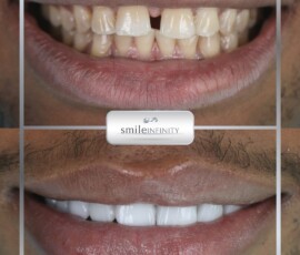 Full smile makeover with veneers by Dr. Habib Zarifeh. Veneers full smile makeover before and after by Dr. Habib Zarifeh, Smile Infinity Beirut, Lebanon