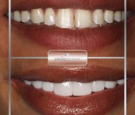 Before and after - ZEvolution veneers. ZEvolution veneers before and after, Smile Infinity Beirut, Lebanon