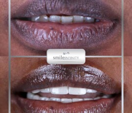 ZEvolution veneers - Dr. Habib Zarifeh's signature protocol. ZEvolution veneers Hollywood Smile result, Smile Infinity Beirut, Lebanon