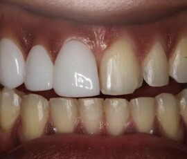 A single ZEvolution veneer beside a natural tooth - the shade difference. ZEvolution veneer single-tooth shade comparison by Dr. Habib Zarifeh, Smile Infinity Beirut, Lebanon