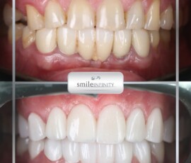 Before and after - zirconium crowns. Zirconium crown before and after, CAD/CAM, Smile Infinity Beirut, Lebanon