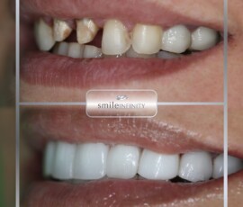 Before and after - zirconium crown restoration. Zirconium crown before and after smile restoration, Smile Infinity Beirut, Lebanon