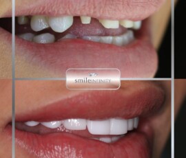 Before and after - zirconium crown Hollywood Smile. Zirconium crown Hollywood Smile before and after, Smile Infinity Beirut, Lebanon