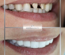 Before and after - zirconium crown smile makeover. Zirconium crown smile makeover before and after, Smile Infinity Beirut, Lebanon