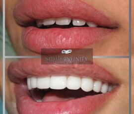 Before and after - zirconium crowns. Zirconium crowns before and after, Smile Infinity Beirut, Lebanon