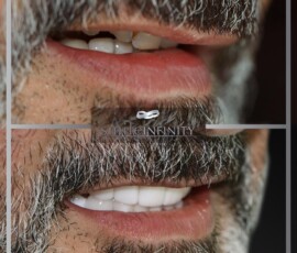 Before and after - zirconium crowns. Zirconium crowns before and after, Smile Infinity Beirut, Lebanon