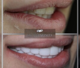 Before and after - zirconium crowns. Zirconium crowns before and after, Smile Infinity Beirut, Lebanon