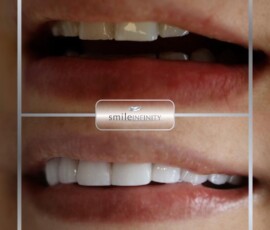 Before and after - zirconium crowns. Zirconium crowns before and after, Smile Infinity Beirut, Lebanon
