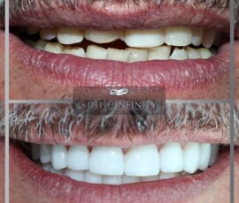 Before and after - zirconium crowns. Zirconium crowns before and after, Smile Infinity Beirut, Lebanon