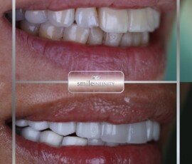 Zirconium crown smile makeover. Zirconium crowns Hollywood Smile makeover before and after, Smile Infinity Beirut, Lebanon